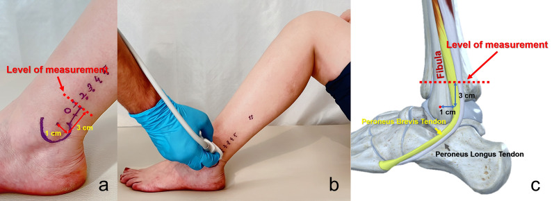 Relationship between peroneus longus tendon graft thickness and anthropometric variables: a radiographic study using ultrasonography.