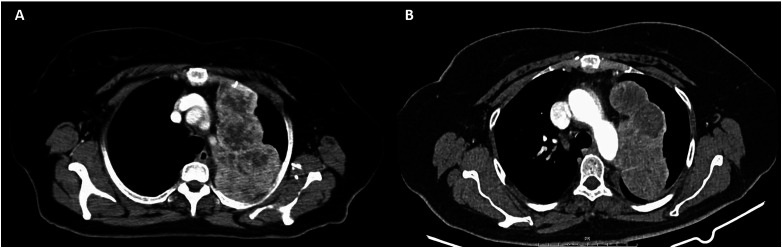 Primary Pulmonary Leiomyosarcoma Managed With Pazopanib: A Case Report and Literature Review.