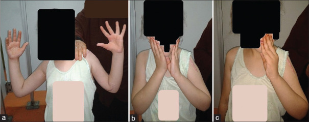 Staged Shoulder and Elbow Reconstruction in a Child with Obstetric Brachial Plexus Palsy: Six-year Follow-up.