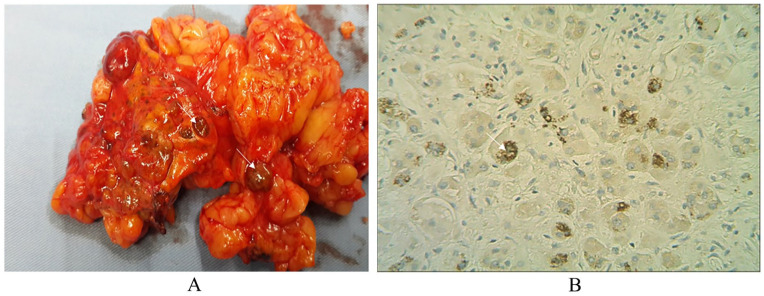 Male Infertility associated with a Novel <i>PRKAR1A</i> Mutation in Carney Complex.