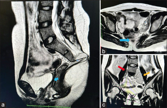 Branch retinal artery occlusion in a young patient with Mayer-Rokitansky-Küster-Hauser type 2 syndrome.