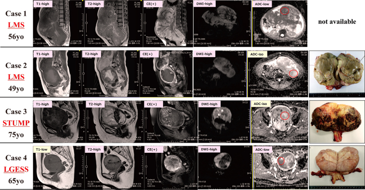 The utility of MRI for the preoperative differential diagnosis of uterine sarcoma and leiomyoma: a single-center study.