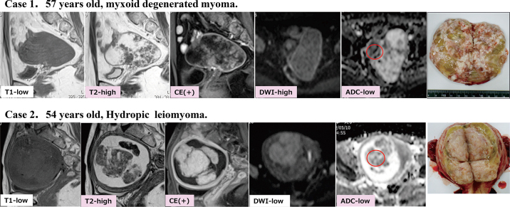 The utility of MRI for the preoperative differential diagnosis of uterine sarcoma and leiomyoma: a single-center study.