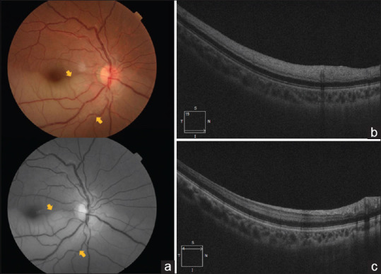 Branch retinal artery occlusion in a young patient with Mayer-Rokitansky-Küster-Hauser type 2 syndrome.