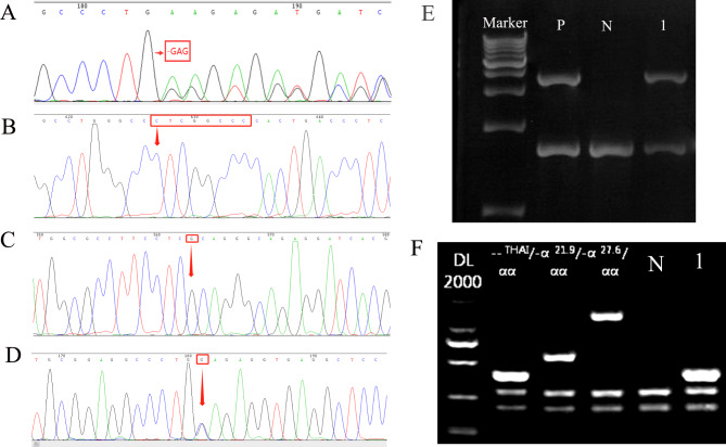 Application of third-generation sequencing technology for identifying rare α- and β-globin gene variants in a Southeast Chinese region.