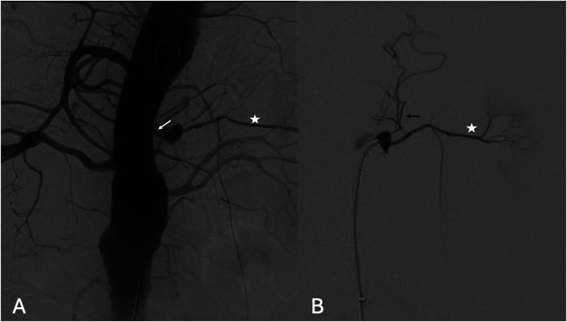Physician-modified funnel-shaped covered stent for selective false lumen exclusion in chronic type B aortic dissection.