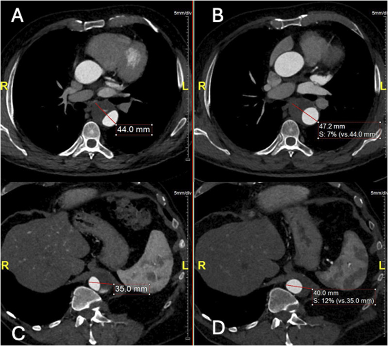 Physician-modified funnel-shaped covered stent for selective false lumen exclusion in chronic type B aortic dissection.