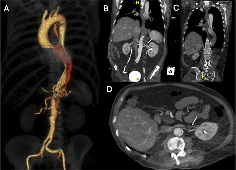 Physician-modified funnel-shaped covered stent for selective false lumen exclusion in chronic type B aortic dissection.