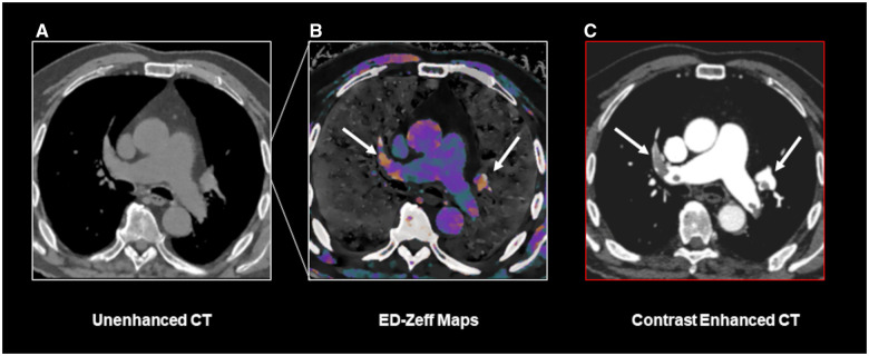Pulmonary embolism detection without intravenous contrast using electron density and Z-effective maps from dual-energy CT.