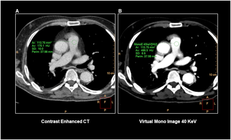 Pulmonary embolism detection without intravenous contrast using electron density and Z-effective maps from dual-energy CT.