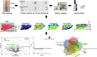 Spatial metabolomics to discover hypertrophic scar relevant metabolic alterations and potential therapeutic strategies: A preliminary study