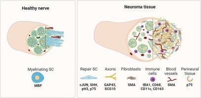 Nerve injury converts Schwann cells in a long-term repair-like state in human neuroma tissue