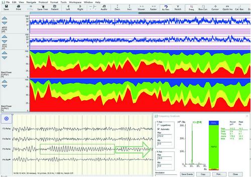 Quantitative Electroencephalography Monitoring in Type A Aortic Dissection Surgery: A Clinical Case Review and Prospective Applications