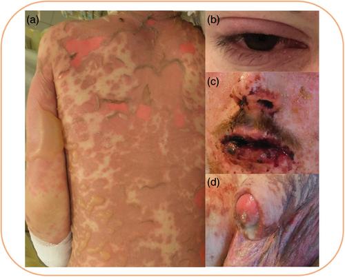 S3-Leitlinie: Diagnostik und Therapie der epidermalen Nekrolyse (Stevens-Johnson-Syndrom und toxisch epidermale Nekrolyse) – Teil 1: Diagnostik, initiales Management und immunmodulierende Systemtherapie