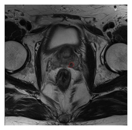 Multifocality and Detectability of Prostate Cancer with 3-Tesla Multiparametric Magnetic Resonance Imaging: Correlation with Radical Prostatectomy Mapping Histopathology