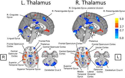 Thalamocortical Dysconnectivity in Treatment-Resistant Depression