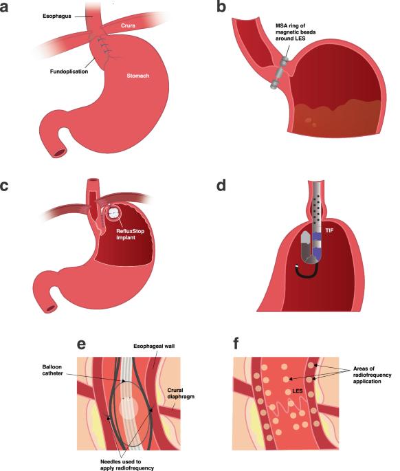 Improving treatment of people with gastro-esophageal reflux disease refractory to proton pump inhibitors