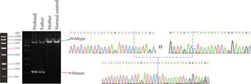 Exonic Deletions and Deep Intronic Variants of the SLC26A4 Gene Contribute to the Genetic Diagnosis of Unsolved Patients With Enlarged Vestibular Aqueduct