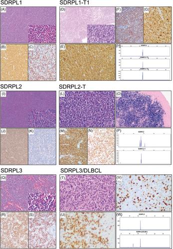 The genomic landscape of transformed splenic diffuse red pulp small B-cell lymphoma