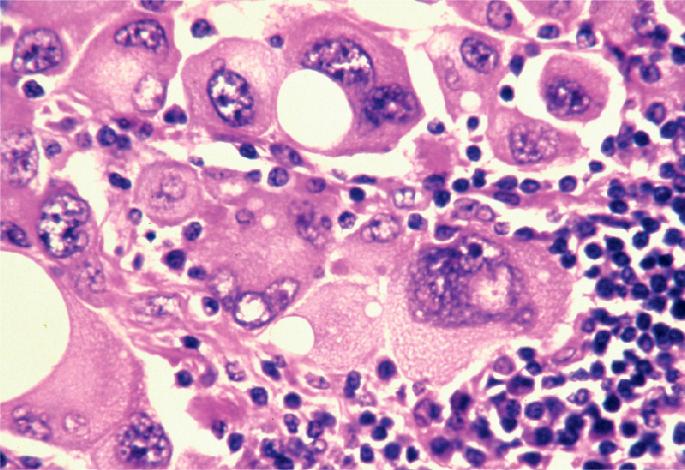 Sex dimorphism in the aged melanoma microenvironment