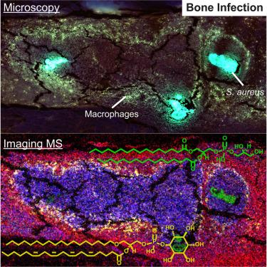 Uncovering lipid dynamics in Staphylococcus aureus osteomyelitis using multimodal imaging mass spectrometry