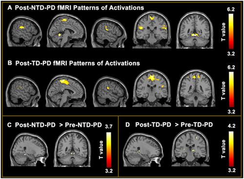 Rehabilitation Response in Tremor- and Non-Tremor-Dominant Parkinson Disease: A Task-fMRI Study