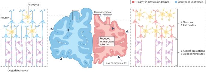 Consequences of trisomy 21 for brain development in Down syndrome