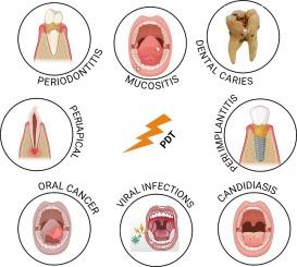 Photodynamic therapy: An emerging therapeutic modality in dentistry