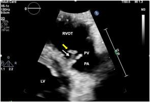 Epicardial Lead Pacer Wire Migration Causing Endocarditis in an Orthotopic Heart Transplant Patient