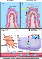 Choroid plexus CCL2‒CCR2 signaling orchestrates macrophage recruitment and cerebrospinal fluid hypersecretion in hydrocephalus