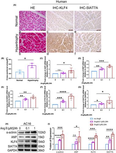 Role of KLF4 and SIAT7A interaction accelerates myocardial hypertrophy induced by Ang II