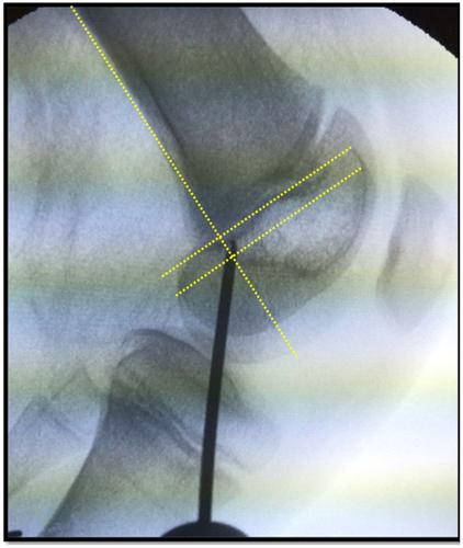 Anatomic physeal-sparing MPFL reconstruction in skeletally immature patients shows favourable outcomes at a minimum of 24-month follow-up