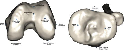 Variability of three-dimensional knee morphology cannot be effectively assessed using a coronal plane knee alignment classification in total knee arthroplasty patients