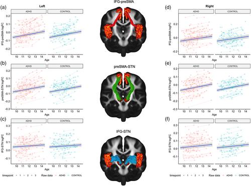 Developmental patterns of inhibition and fronto-basal-ganglia white matter organisation in healthy children and children with attention-deficit/hyperactivity disorder