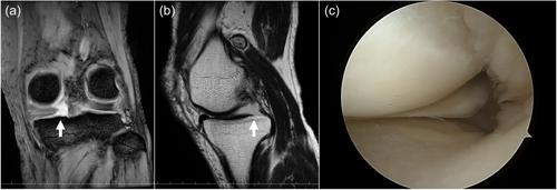 Mid-term patient-reported outcomes are inferior in opening-wedge high tibial osteotomy patients with untreated medial meniscus posterior root tear