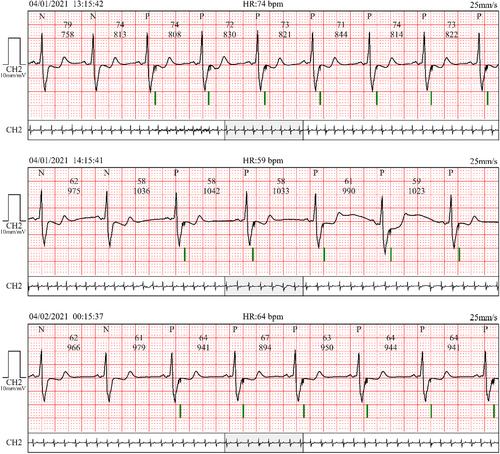 Biotronik Implantable Cardioverter Defibrillator for Measurement of Intrathoracic Impedance: A Report of Two Cases