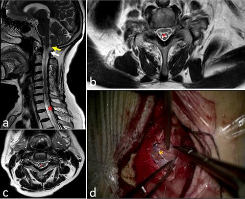 Spinal Adhesive Arachnoidopathy, the Disorder More Than Simply Adhesive Arachnoiditis: A Comprehensive Systematic Review of 510 Cases