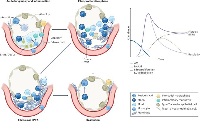 Monocyte-derived macrophages are too much of a good thing in lung fibrosis