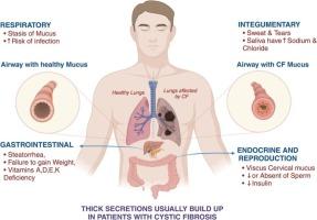 Precision medicine advances in cystic fibrosis: Exploring genetic pathways for targeted therapies