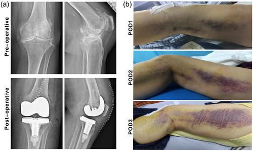 Personalized delayed anticoagulation therapy alleviates postoperative bleeding in total knee arthroplasty (TKA) patients