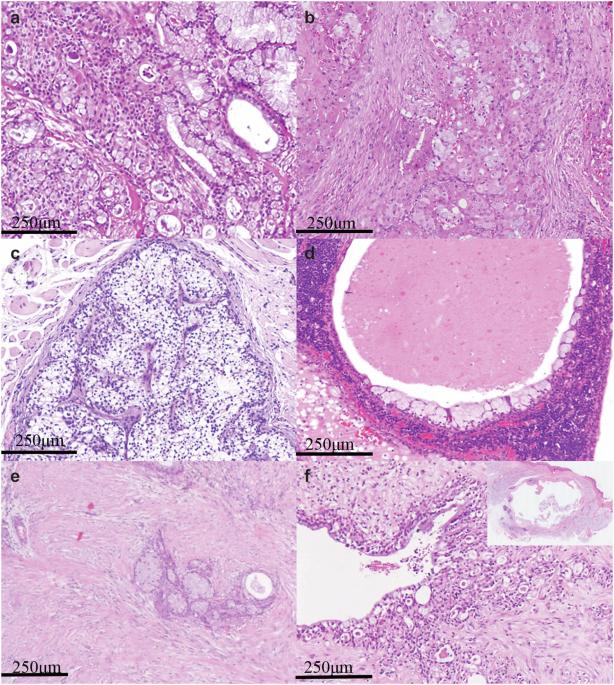 The clinical outcome, pathologic spectrum, and genomic landscape for 454 cases of salivary mucoepidermoid carcinoma