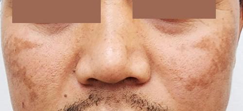 Melasma in the male: a less well recognised entity