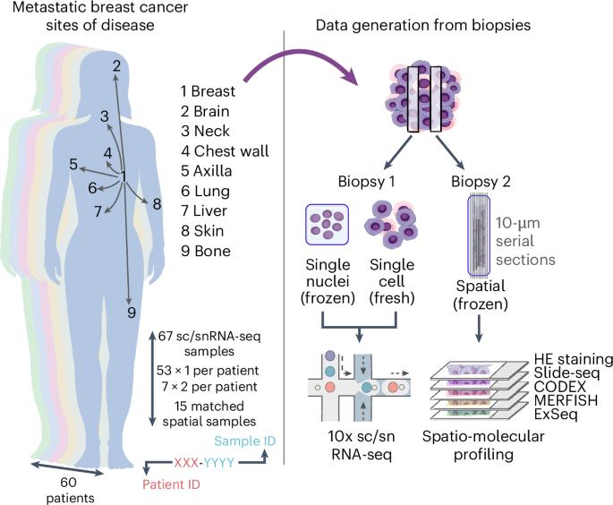 Mapping metastatic breast cancer complexity through single-cell and spatial profiling