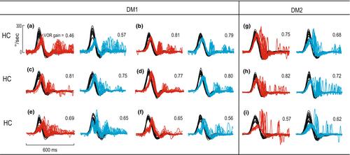 Video head impulse gain is impaired in myotonic dystrophy types 1 and 2