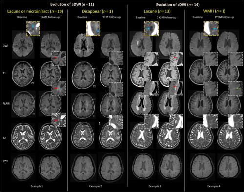 Characteristics and temporal evolution of asymptomatic diffusion-weighted imaging lesions in patients with cerebral autosomal dominant arteriopathy with subcortical infarcts and leukoencephalopathy (CADASIL)