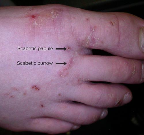 Scabies: a clinical update.