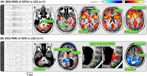 Clinical trials for Lennox-Gastaut syndrome: Challenges and priorities.