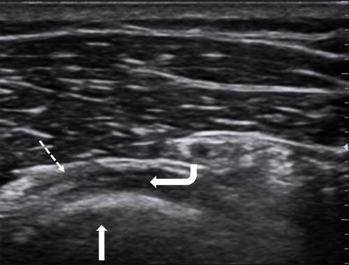 Neuromuscular ultrasound for the differential diagnosis of radial tunnel syndrome and lateral epicondylitis