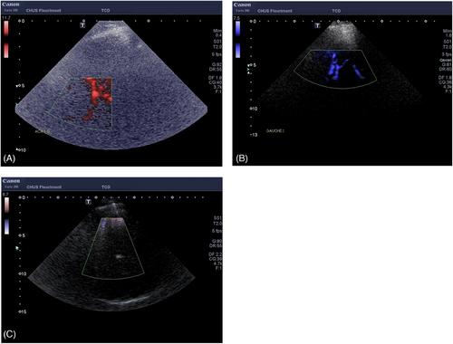 Continuous transcranial ultrasound in large vessel stroke: Image guidance for high-intensity focused sonothrombolysis