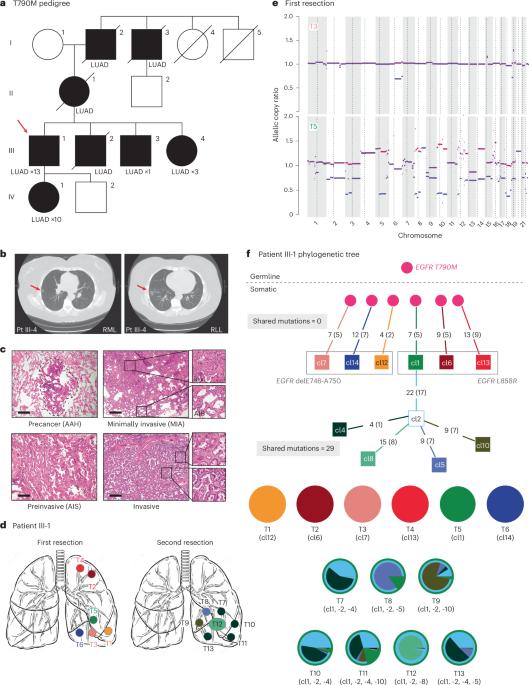 Developmental mosaicism underlying EGFR-mutant lung cancer presenting with multiple primary tumors